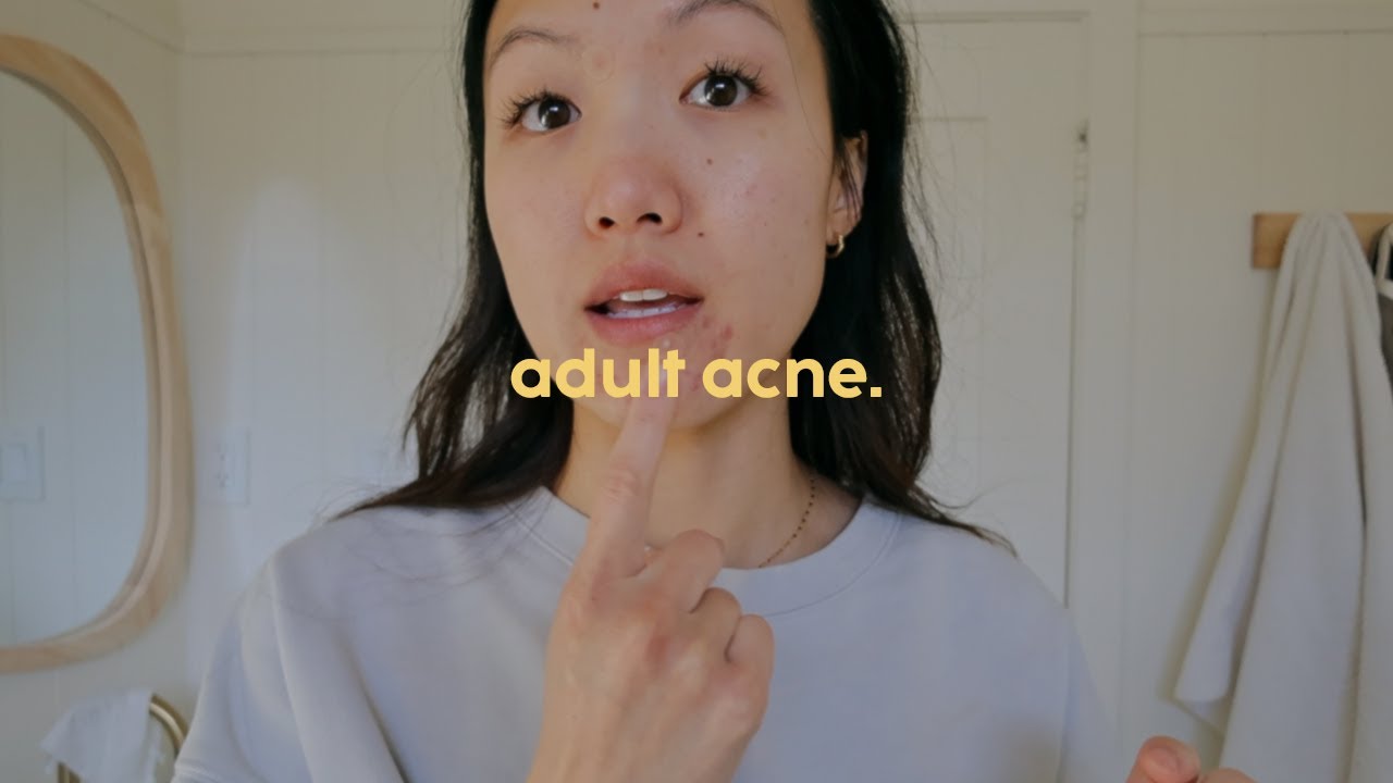 the ongoing struggle with adult acne, procrastination, and self-confidence
